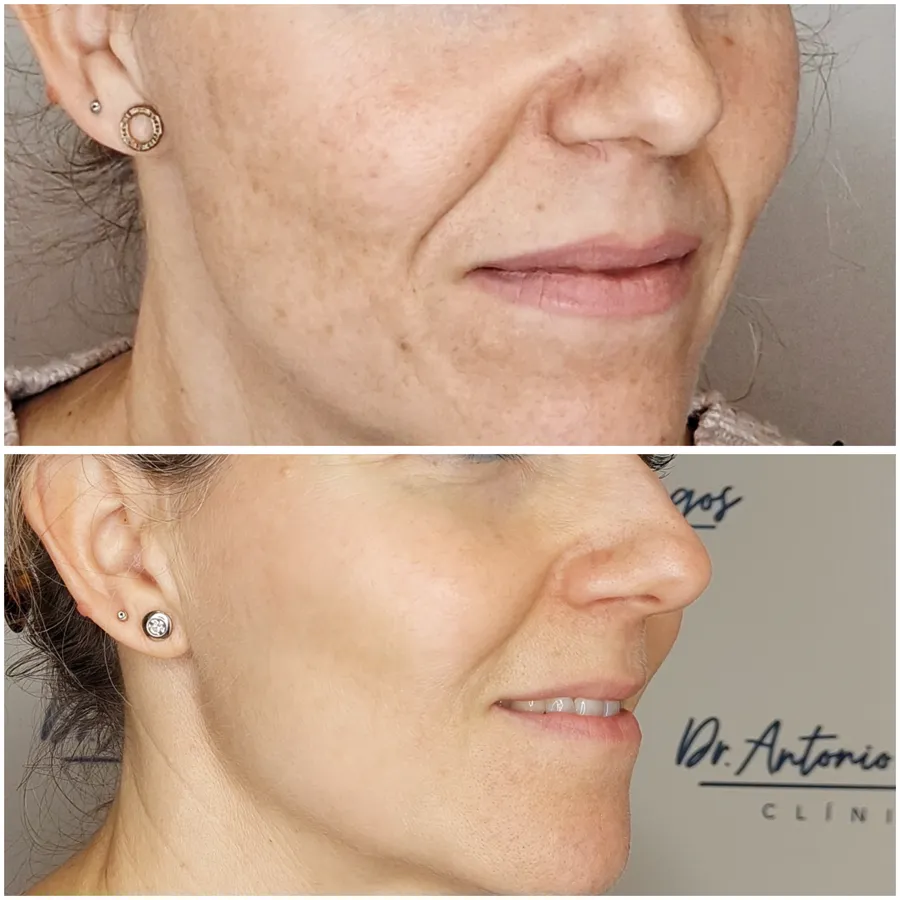 Antes y después de armonización facial, perspectiva 1