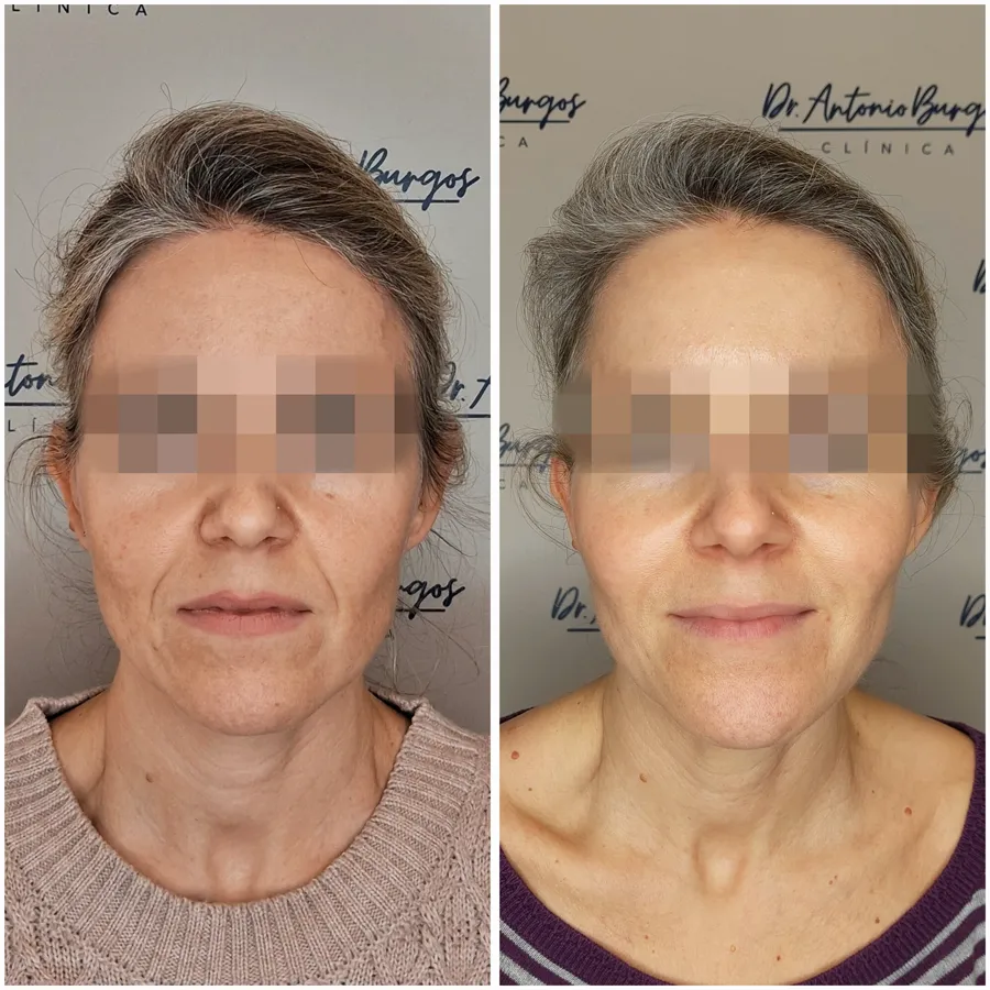 Antes y después de armonización facial, perspectiva 2