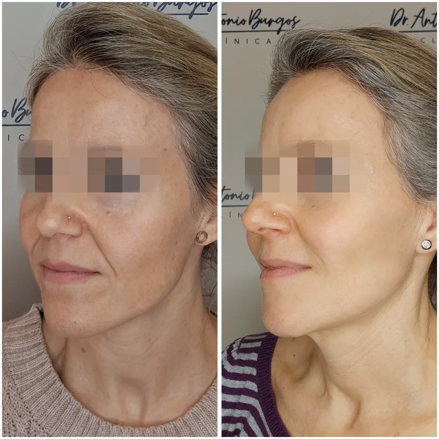Antes y después de armonización facial, perspectiva 3