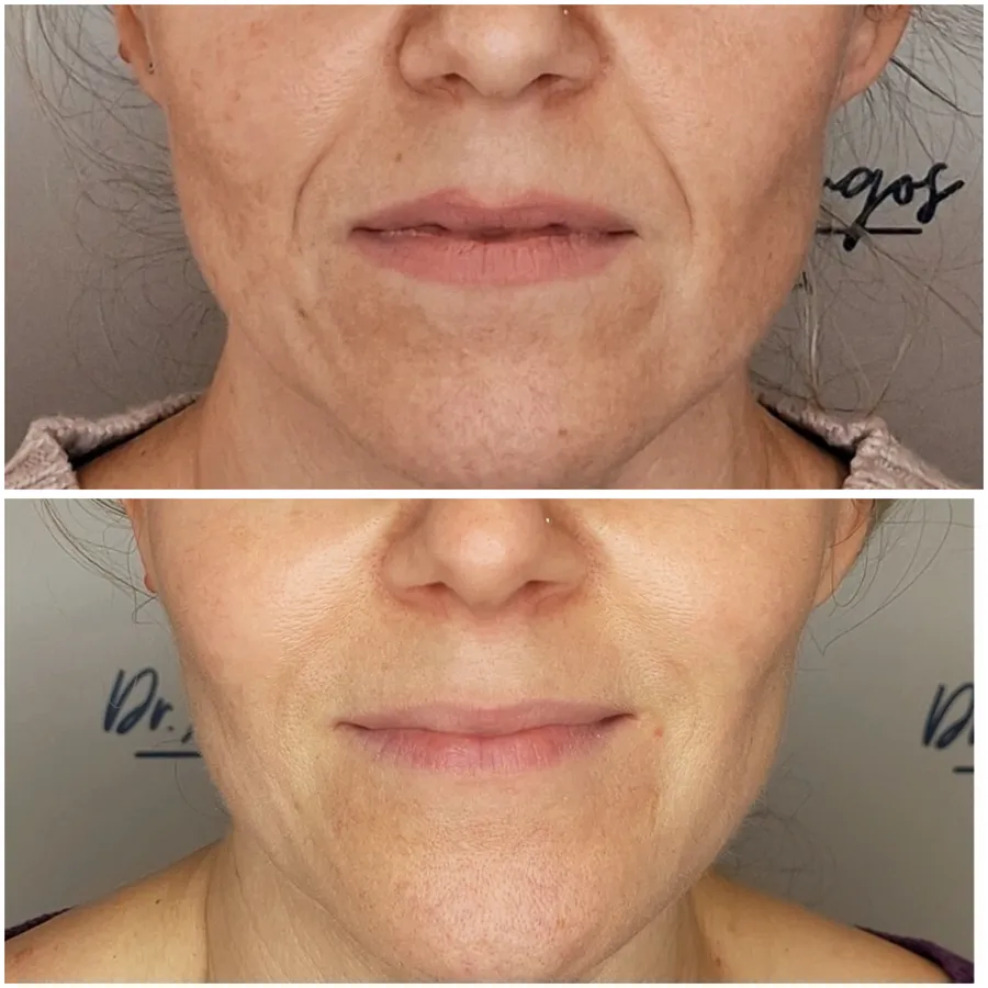 Antes y después de armonización facial, perspectiva 4