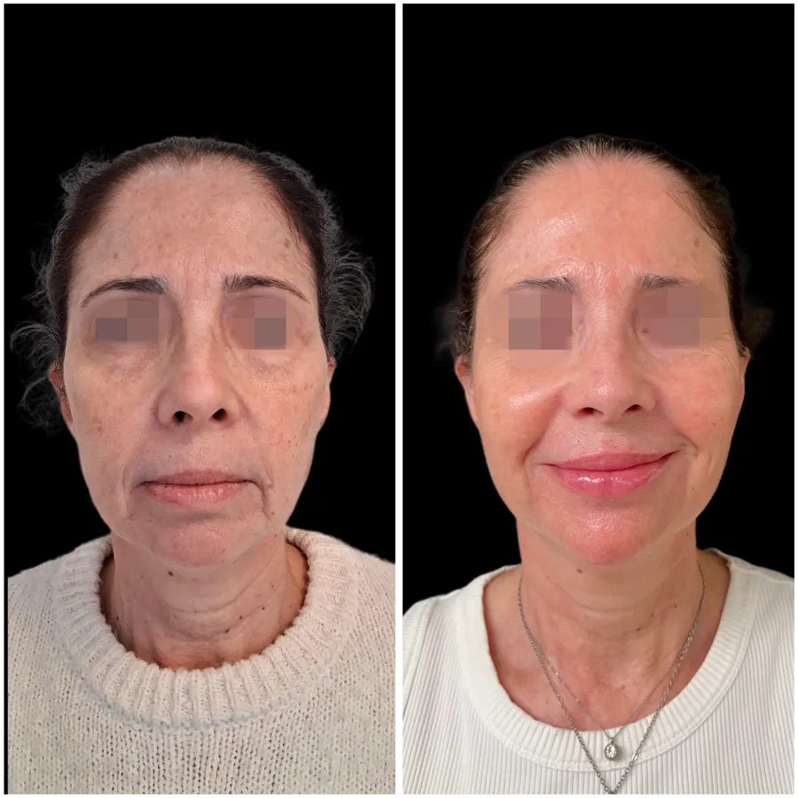 Antes y después de armonización facial caso 2, perspectiva principal