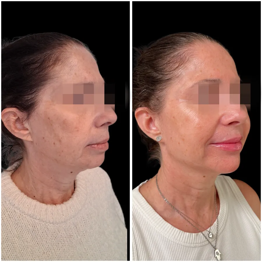 Antes y después de armonización facial caso 2, perspectiva 2