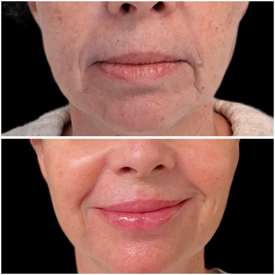 Antes y después de armonización facial caso 2, perspectiva 3