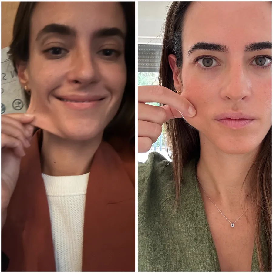 Antes y después de tratamiento de flacidez en mujer joven