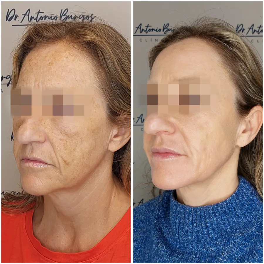 Antes y después de tratamiento de flacidez caso 2, perspectiva 1