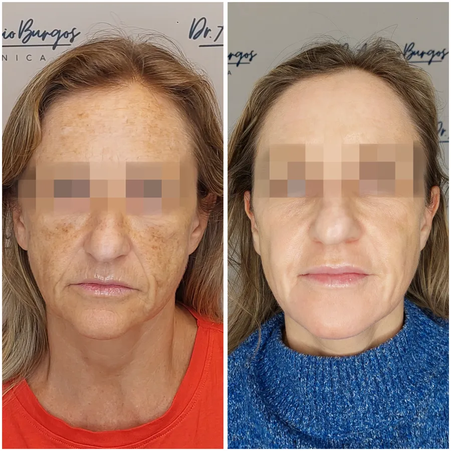 Antes y después de tratamiento de flacidez caso 2, perspectiva 3