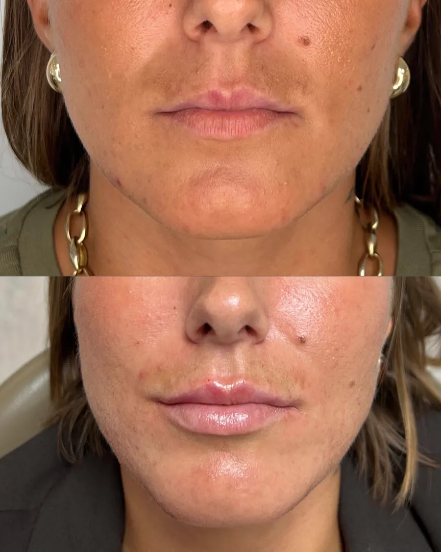Antes y después de relleno labial en mujer joven con labios finos