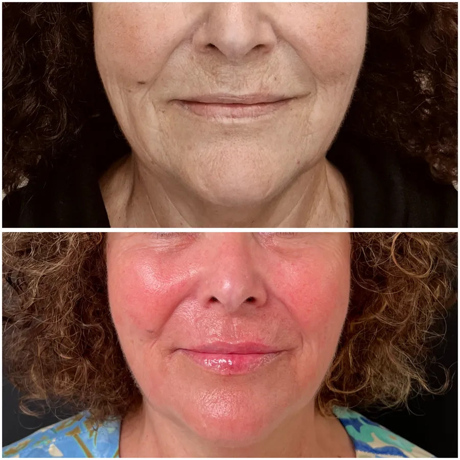 Antes y después de relleno labial en mujer madura, ángulo 2
