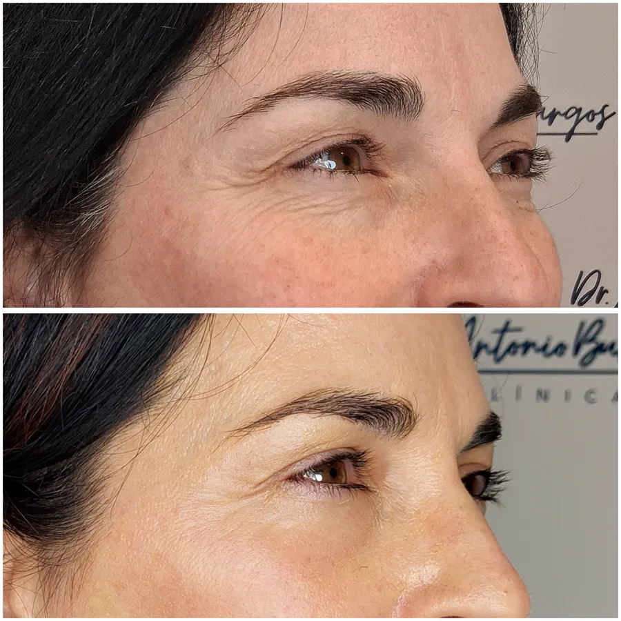 Antes y después de tratamiento periocular, perspectiva 1