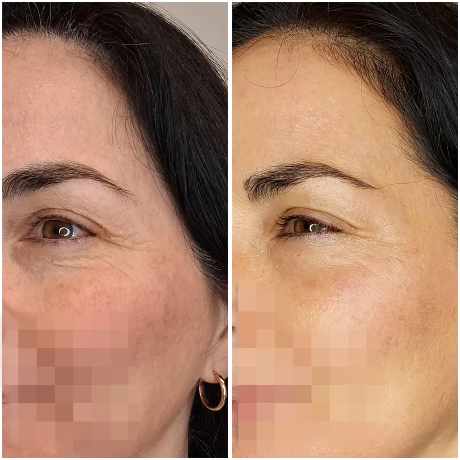 Antes y después de tratamiento periocular, perspectiva 2