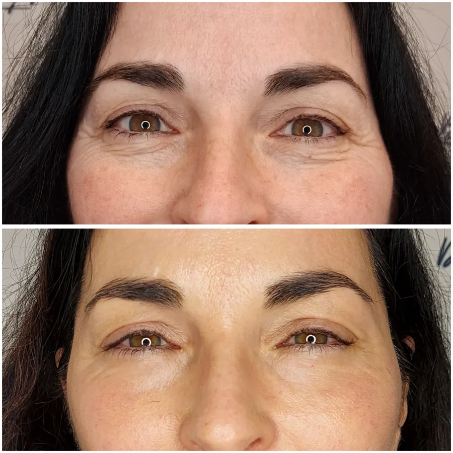 Antes y después de tratamiento periocular, perspectiva 3